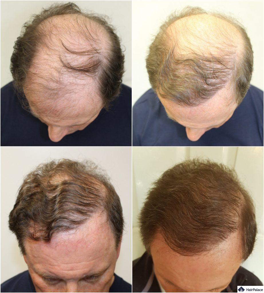 Drei Haartransplantationen Eine Unglaubliche Verwandlung