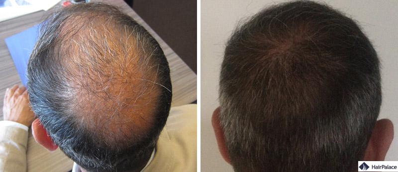 implant cheveux