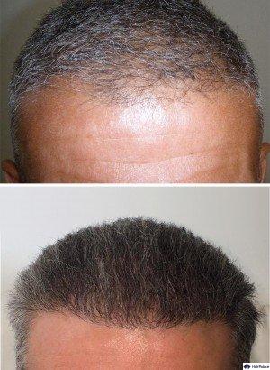 Billige haartransplantation kosten