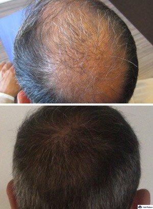 FUE haartransplantation Alexandre