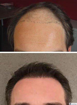 FUE haartransplantation deutschland