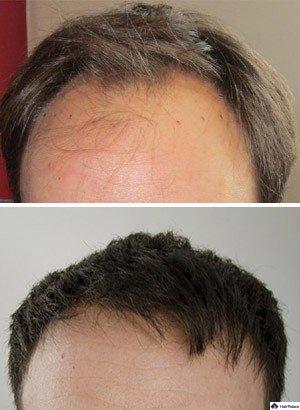 Haartransplantation Christophe