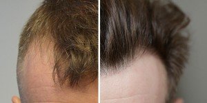 Haartransplantation referenzen