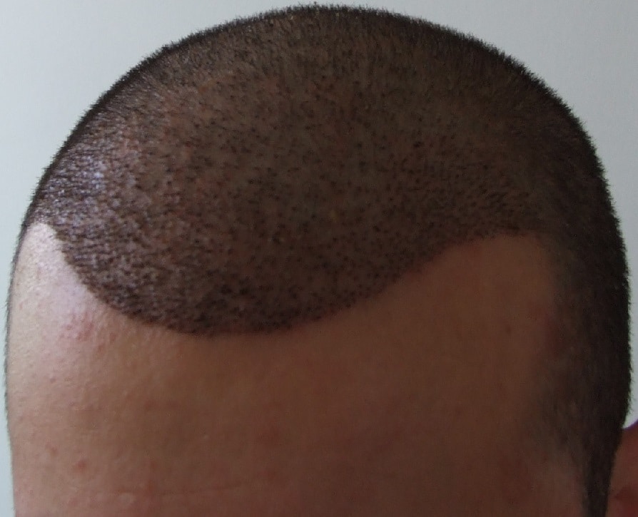 Haartransplantation Meinung Von Laurent 4200 Haare