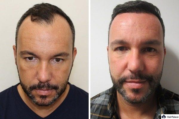 jerome-before-after-wp-8495577