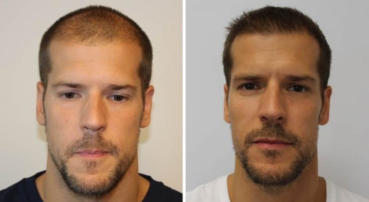 Sam vor und nach der Haartransplantation