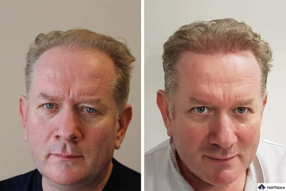Haartransplantation In Frankfurt Am Main