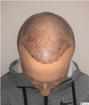 1-woche-nach-dem-haartransplantation-jon