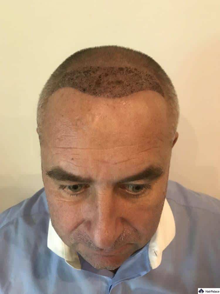 natürliche haarlinie mann 1 woche nach haartransplantation