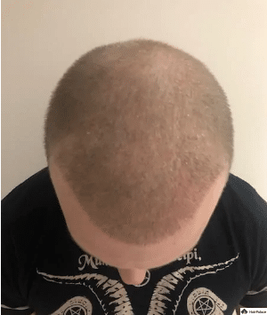 2-wochen-nach-der-haartransplantation-jon