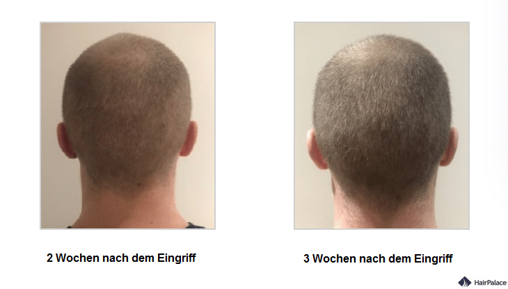 2-und-3-wochen-nach-dem-eingriff-jon