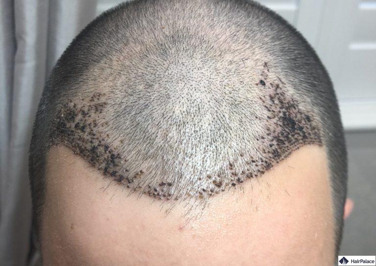 chris-1-woche-nach-der-haartransplant