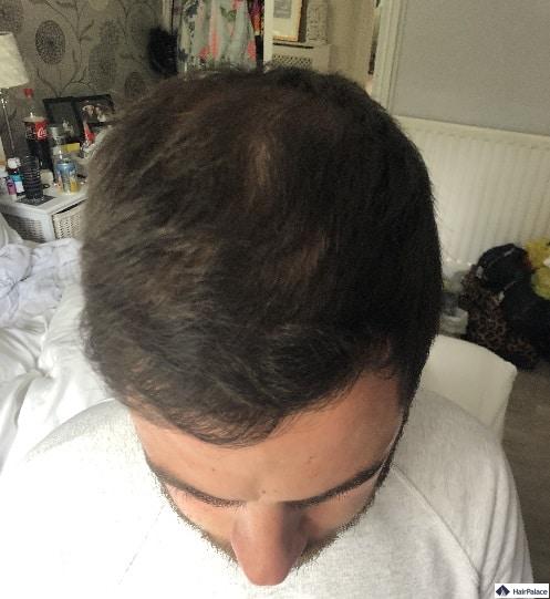 Chris' Haare 6 Monate nach der Implantation