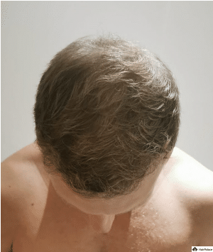 jon-6-monate-nach-der-haartransplantation-1