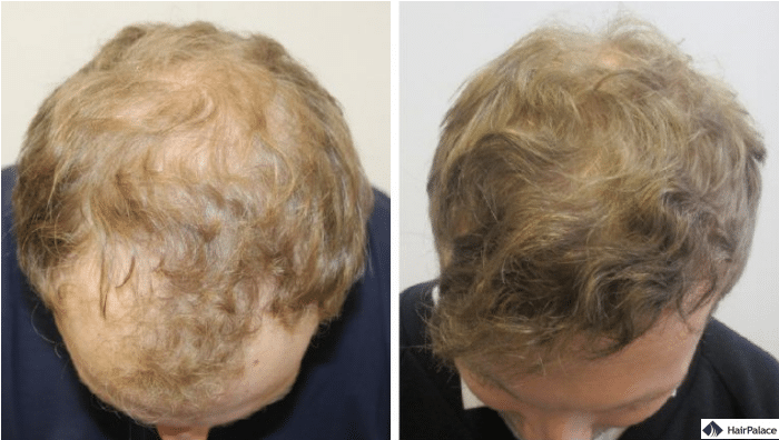 jons-haartransplantation-transformation