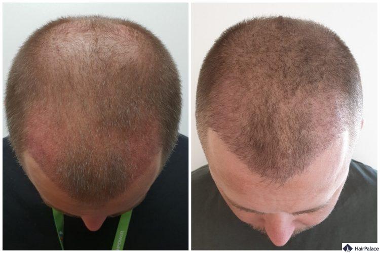 neil-3-wochen-3-monate-nach-haartransplantation