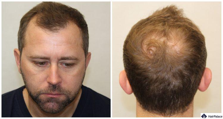 neil-in-consultation-haartransplantation