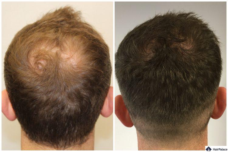 neil-vor-nach-haartransplantation