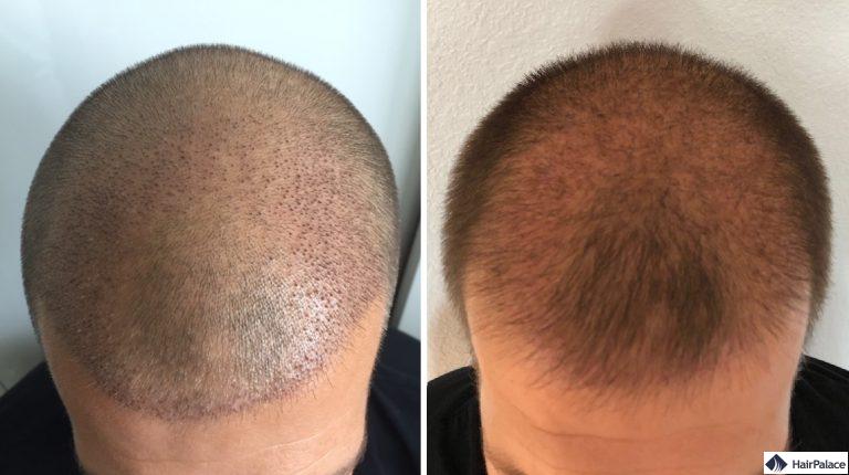 Die Empfängerareale 1 und 3 Wochen nach der Haartransplantation