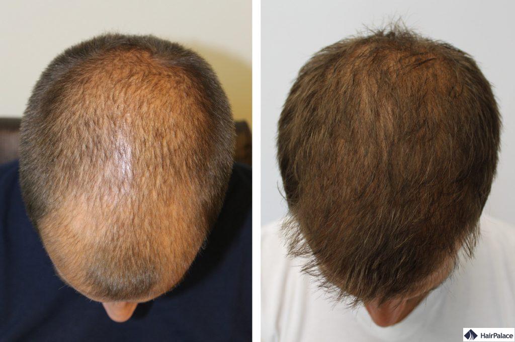 Oberkopf vor und nach der Haartransplant