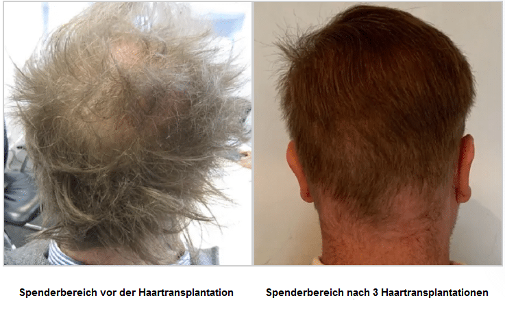 spenderbereich-vor-und-nach-der-haartransplantation-david