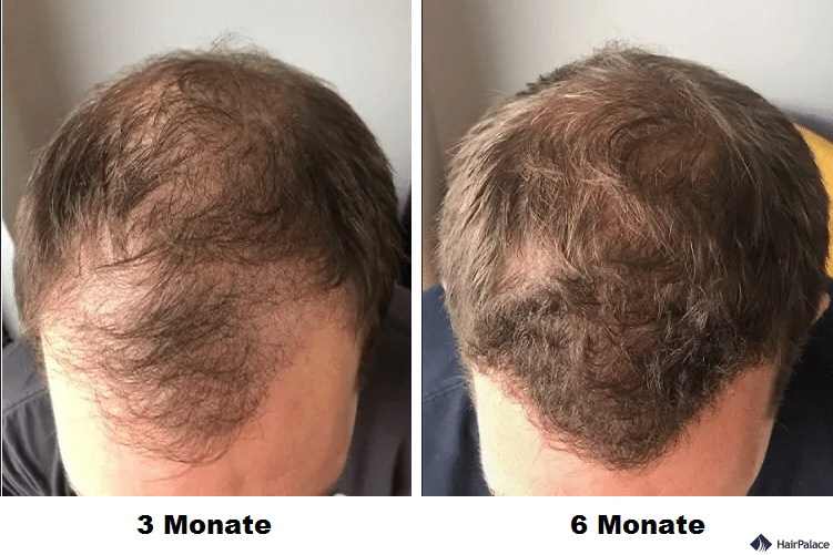 toby-3-months-and-6-months-after-the-fue2-hairtransplant