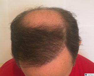 tom-1-jahr-nach-seiner-ersten-haartransplantation