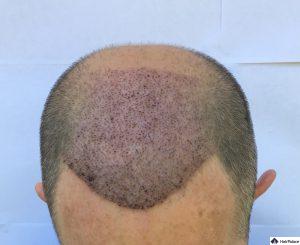 tom-1-woche-nach-seiner-ersten-haartransplantation