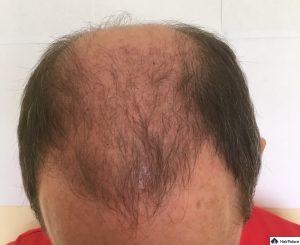 tom-3-monate-nach-seiner-ersten-haartransplantation