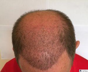 tom-3-wochen-nach-seiner-ersten-haartransplantation