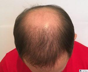 tom-6-monate-nach-seiner-ersten-haartransplantation