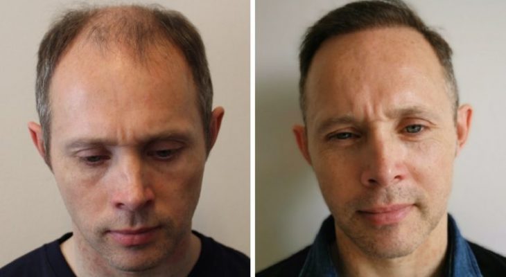 tom-vor-und-nach-seiner-haartransplantation