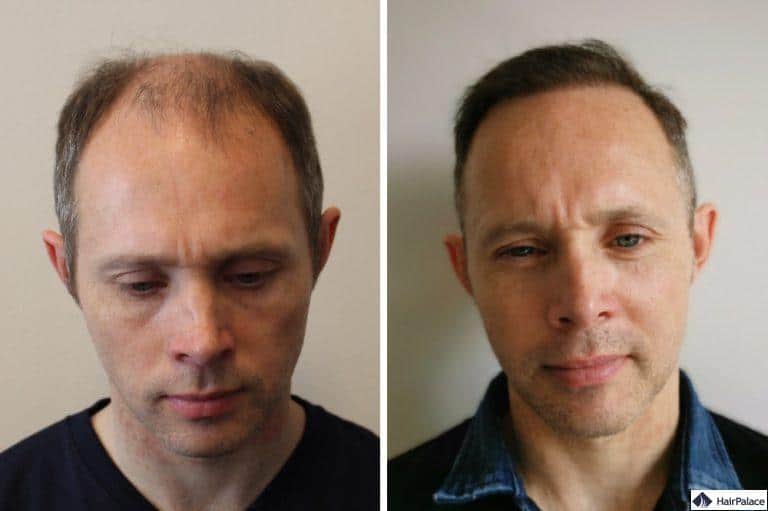 tom-vor-und-nach-seiner-haartransplantation