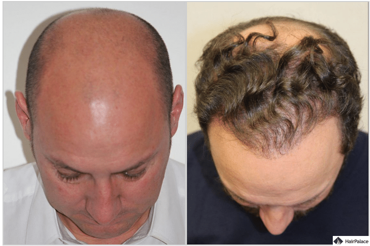 xavier-ergebnis-nach-der-2-haartransplantation