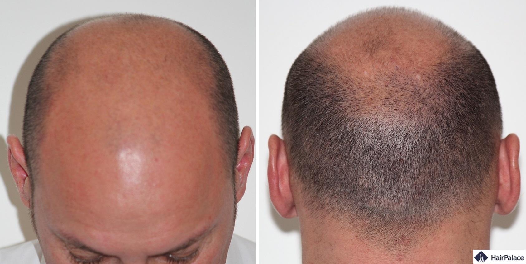 xavier-vor-der-haartransplantation