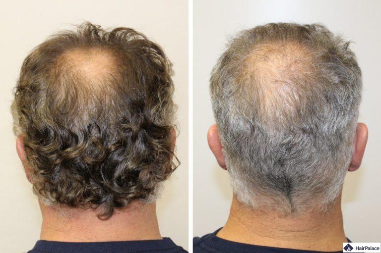 Der Spenderbereich vor und nach der Haartransplantation