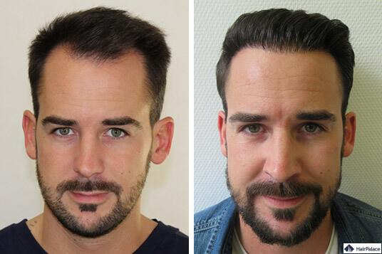 Haartransplantation in Frankfurt Erfolgsgeschichten HairPalace