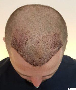 neil-1-woche-nach-fue2-haartransplantation