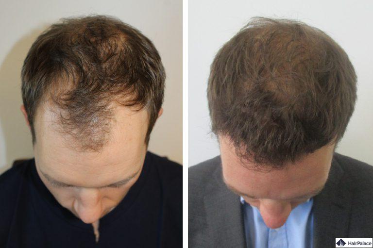 toby-vor-und-nach-der-haartransplantation-operation