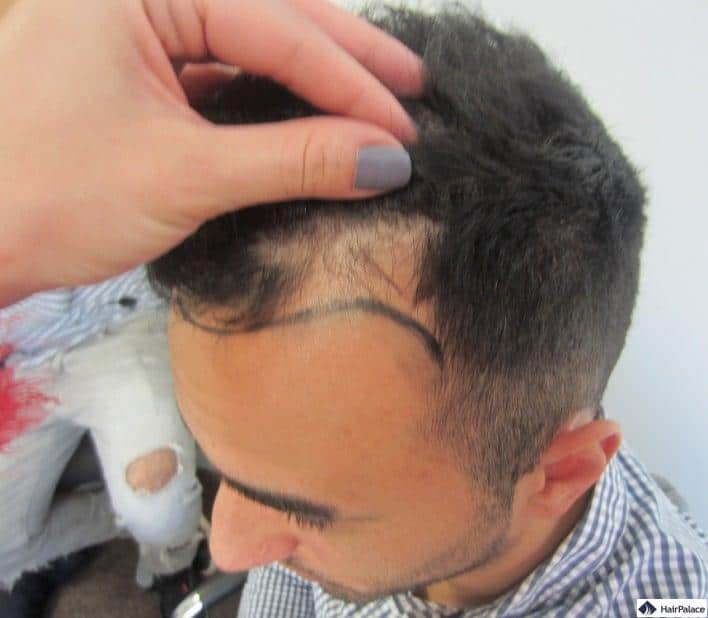 Yohanns Haartransplantation