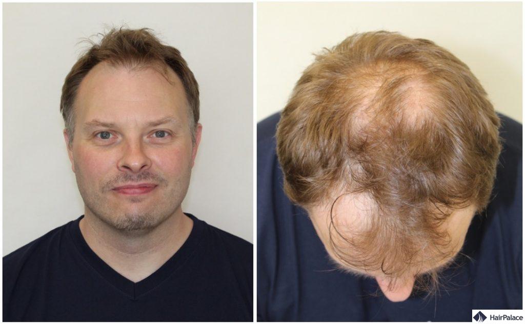 paul-haartransplantation-beratung