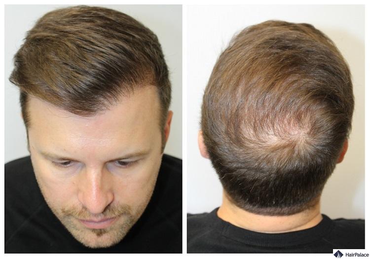 haartransplantation ergebnis peter