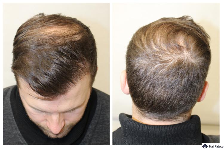 Peter vor und nach der Haartransplantation bei HairPalace