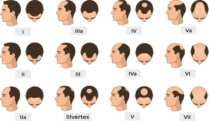 Für haartransplantation kosten Haartransplantation in