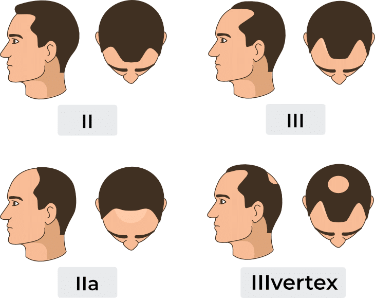 Haartransplantation kosten für Haartransplantation Kosten