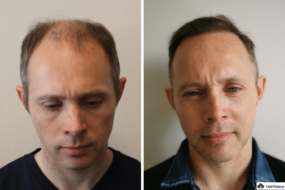 Vorher Nachher der Haartransplantation