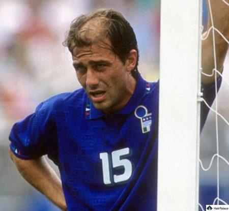 Der junge Antonio Conte vor seiner Haartransplantation