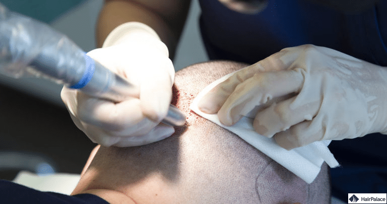 fue2-haartransplantationsmethode