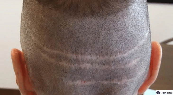 FUT Haartransplantation narben