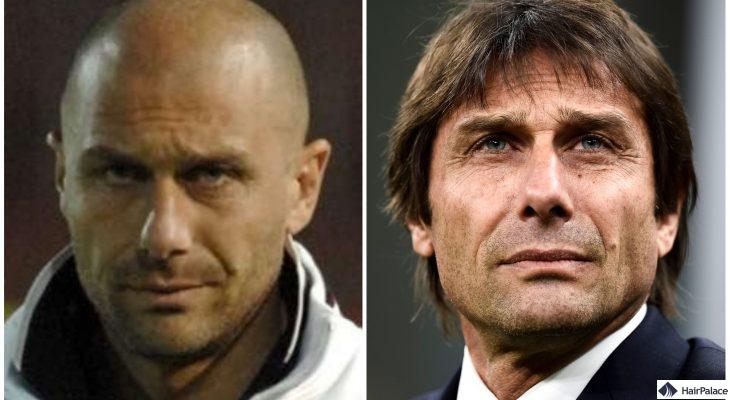 Antonio Conte vor und nach der FUE2-Haartransplantation